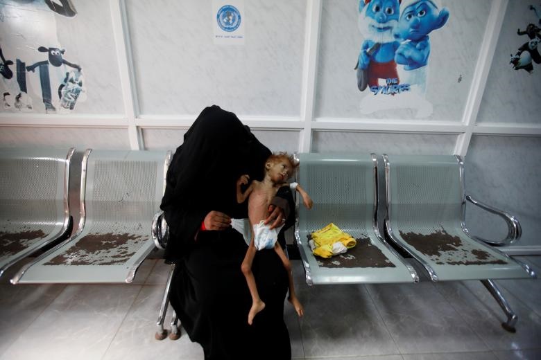 تصاویر دلخراش از کودکان یمنی گرفتار در «بزرگترین بحران قحطی جهان»